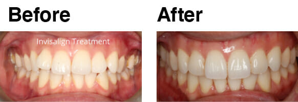 20_40 aligners