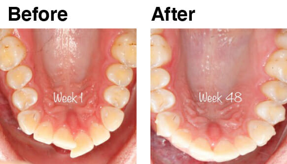 24_48 aligners