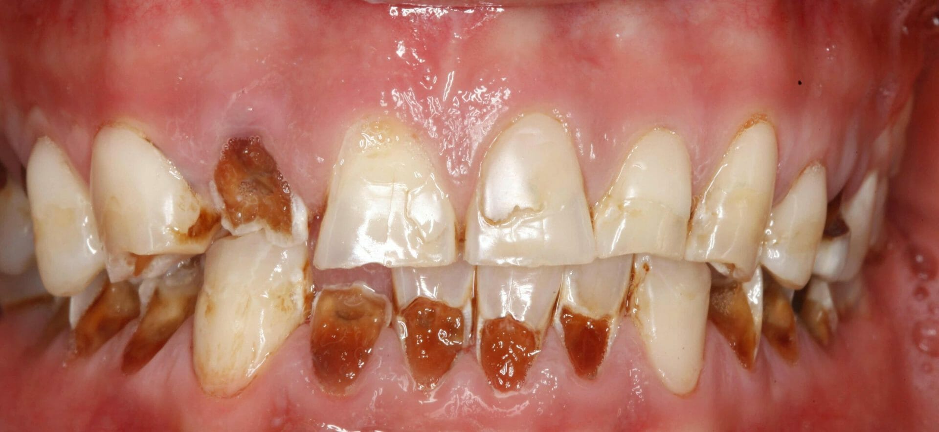 Dental Crowns in Brisbane